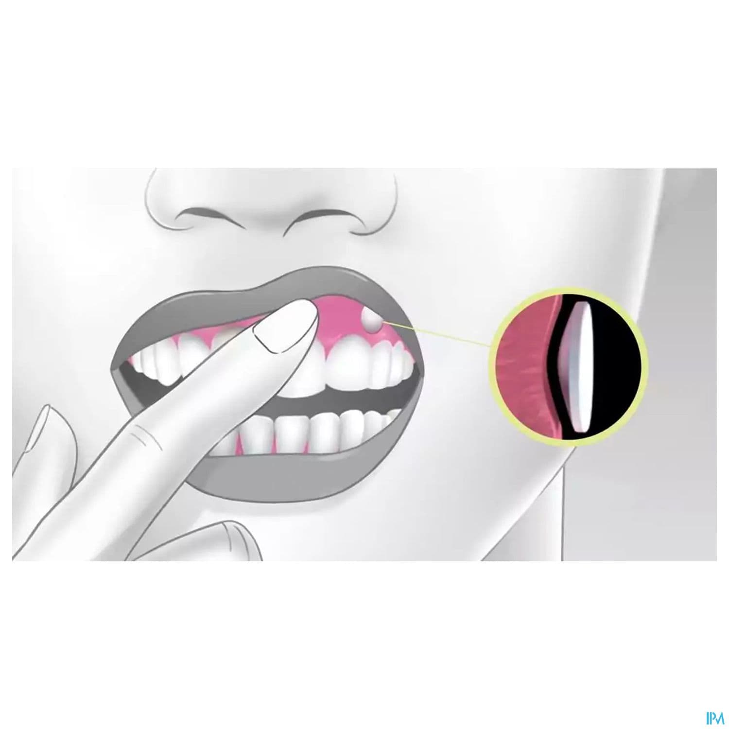 Virpax 50mg Comprime Buccogingival Mucoadhesif 1
